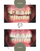 Corone in Zirconia Standard & Monolitica (full zirconia)