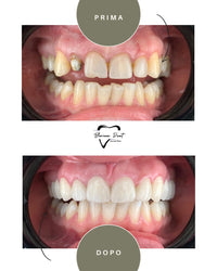 Corone in Zirconia Standard & Monolitica (full zirconia)