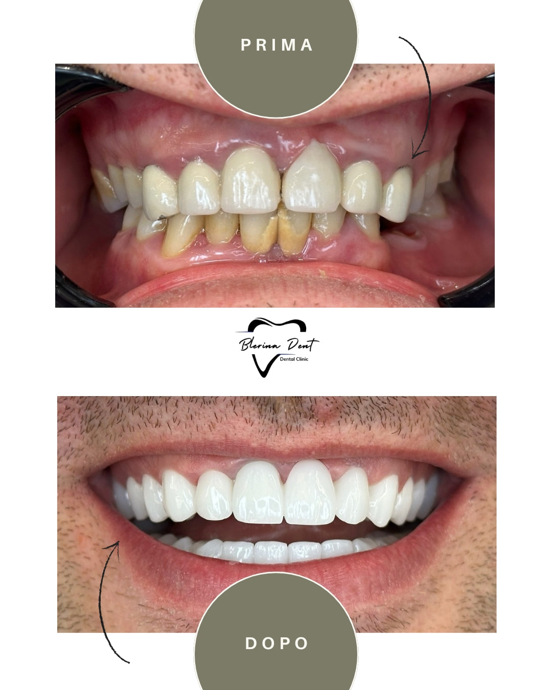 Corone in Zirconia Standard & Monolitica (full zirconia)