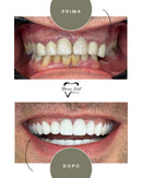 Corone in Zirconia Standard & Monolitica (full zirconia)