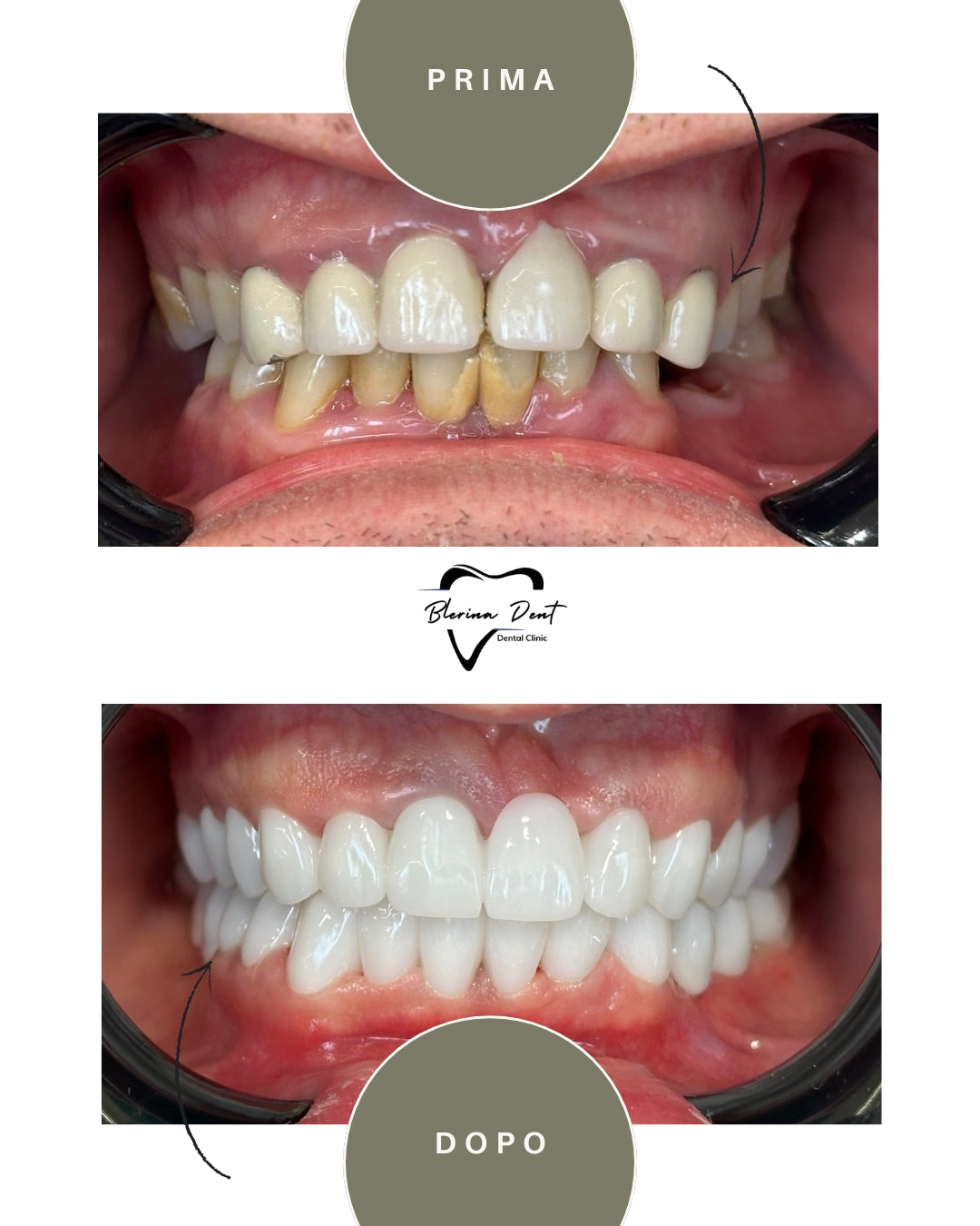 Corone in Zirconia Standard & Monolitica (full zirconia)