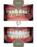 Corone in Zirconia Standard & Monolitica (full zirconia)