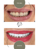 Corone in Zirconia Standard & Monolitica (full zirconia)