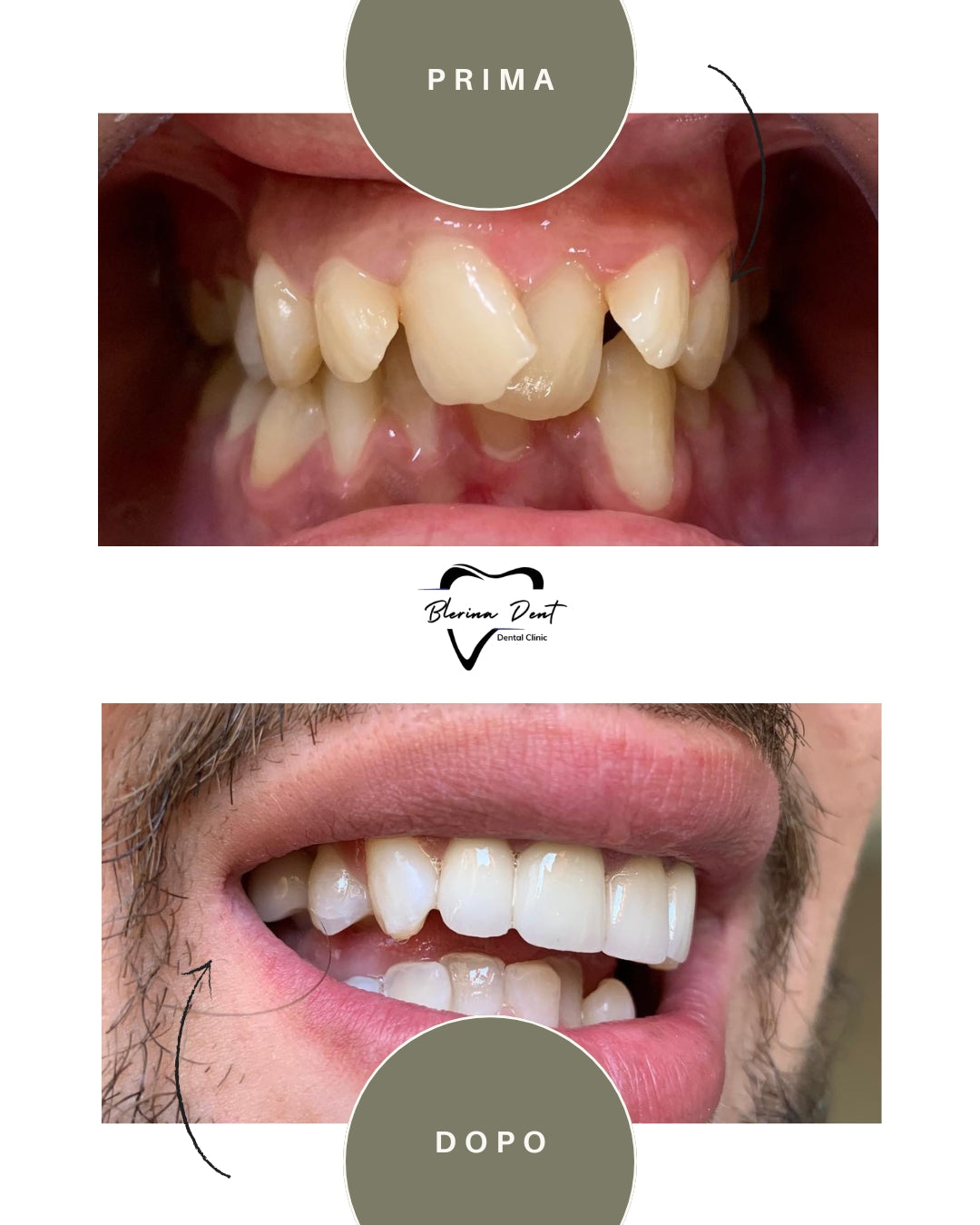 Corone in Zirconia Standard & Monolitica (full zirconia)