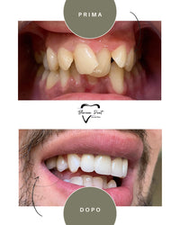 Corone in Zirconia Standard & Monolitica (full zirconia)