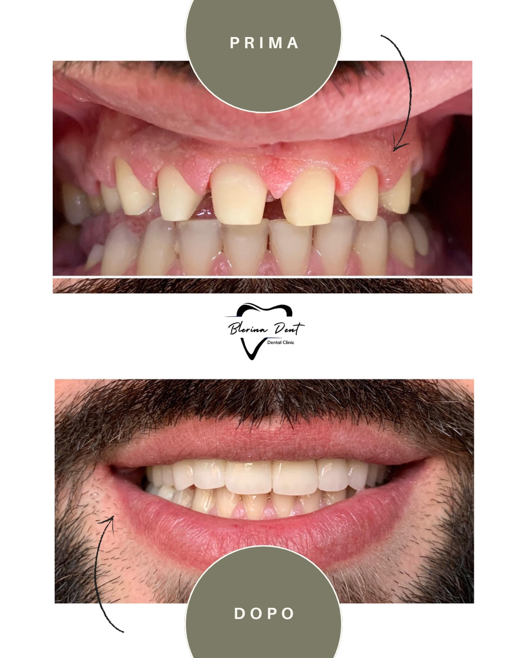 Corone in Zirconia Standard & Monolitica (full zirconia)