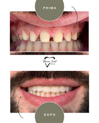 Corone in Zirconia Standard & Monolitica (full zirconia)