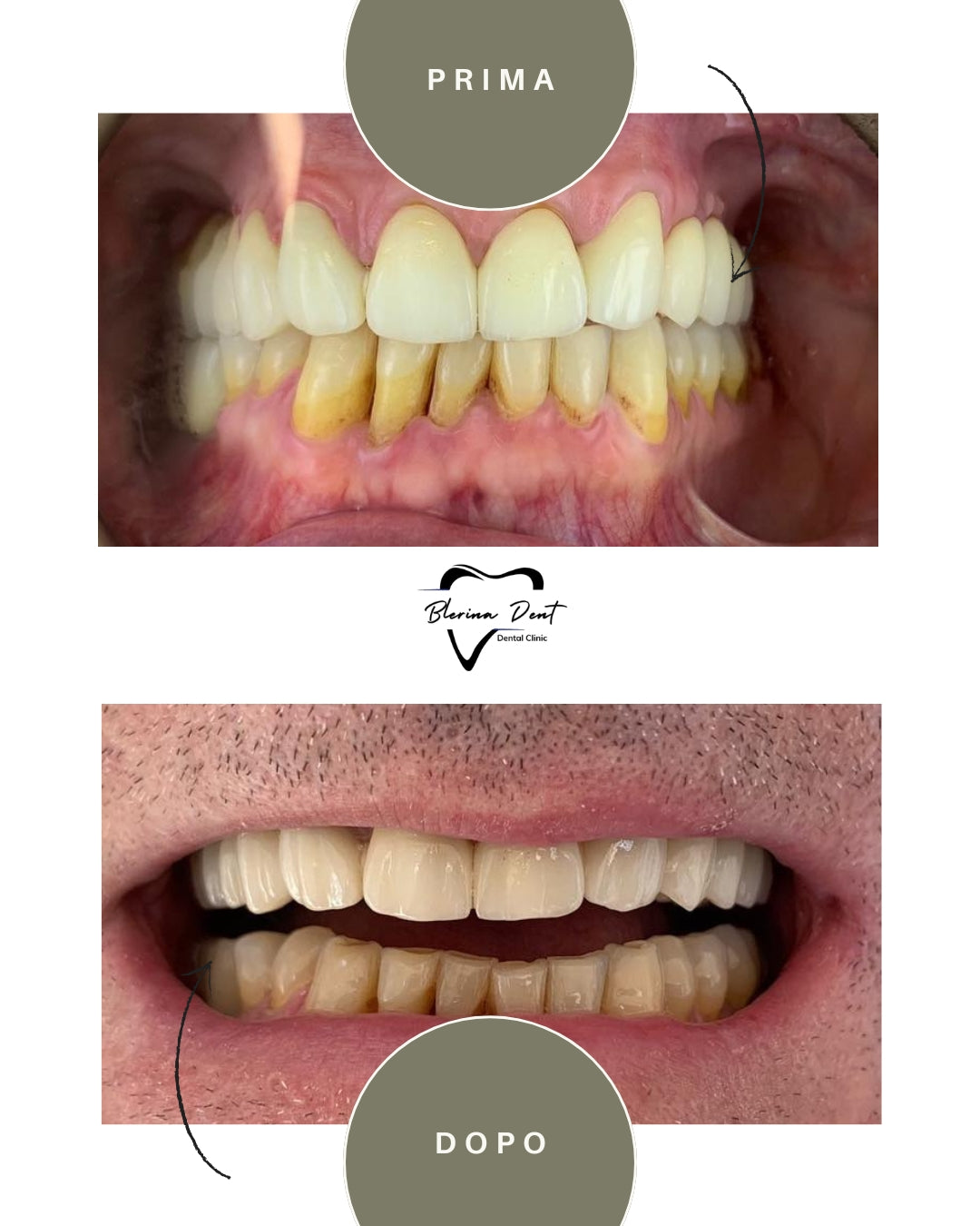 Corone in Zirconia Standard & Monolitica (full zirconia)