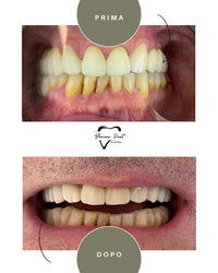 Corone in Zirconia Standard & Monolitica (full zirconia)