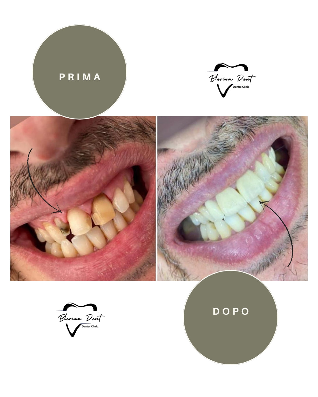 Corone in Zirconia Standard & Monolitica (full zirconia)