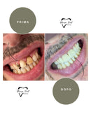 Corone in Zirconia Standard & Monolitica (full zirconia)