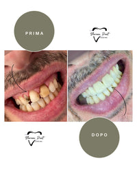 Corone in Zirconia Standard & Monolitica (full zirconia)