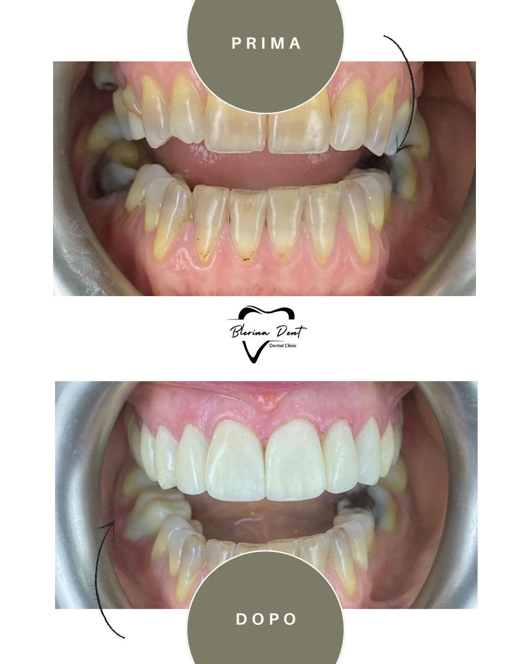 Corone in Zirconia Standard & Monolitica (full zirconia)