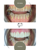 Corone in Zirconia Standard & Monolitica (full zirconia)