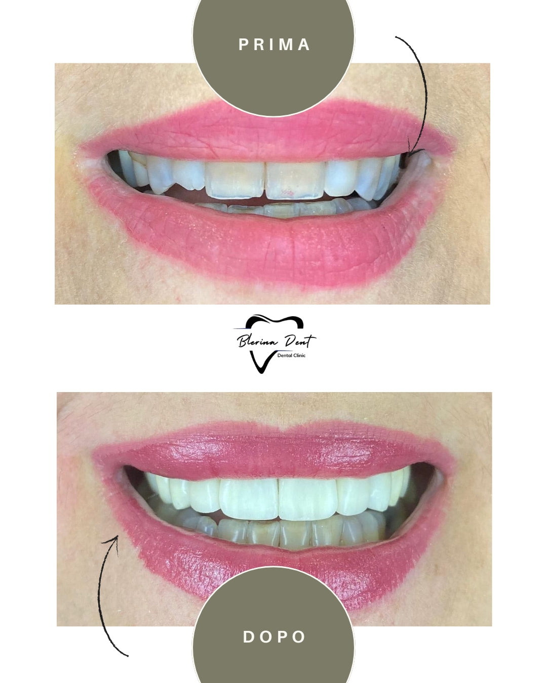 Corone in Zirconia Standard & Monolitica (full zirconia)