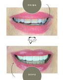 Corone in Zirconia Standard & Monolitica (full zirconia)