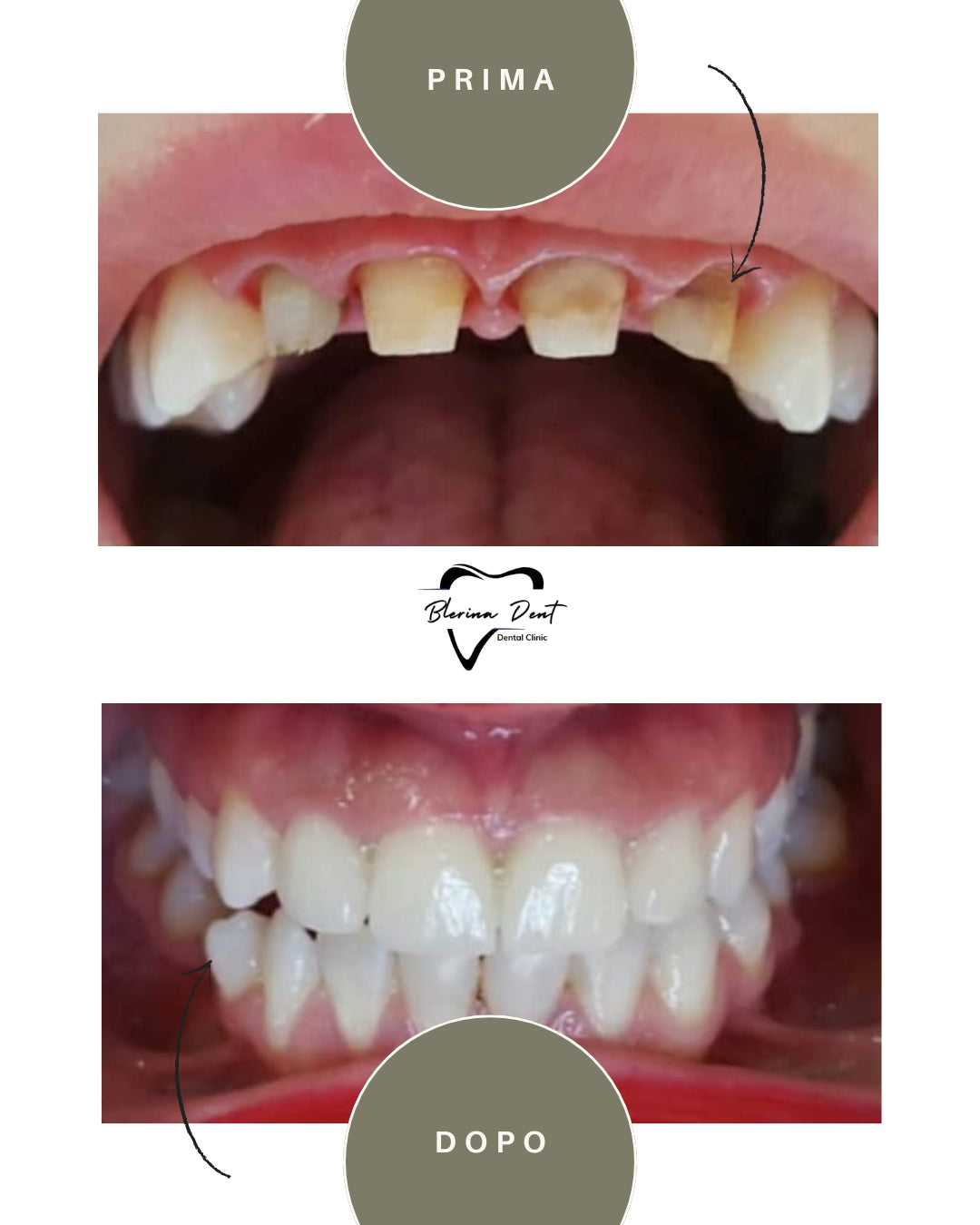Corone in Zirconia Standard & Monolitica (full zirconia)