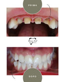 Corone in Zirconia Standard & Monolitica (full zirconia)