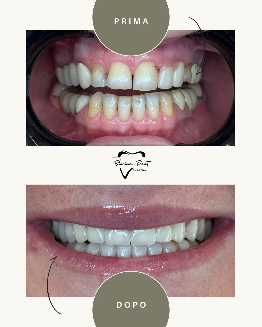Corone metallo-ceramica: estetica e resistenza in un unico trattamento