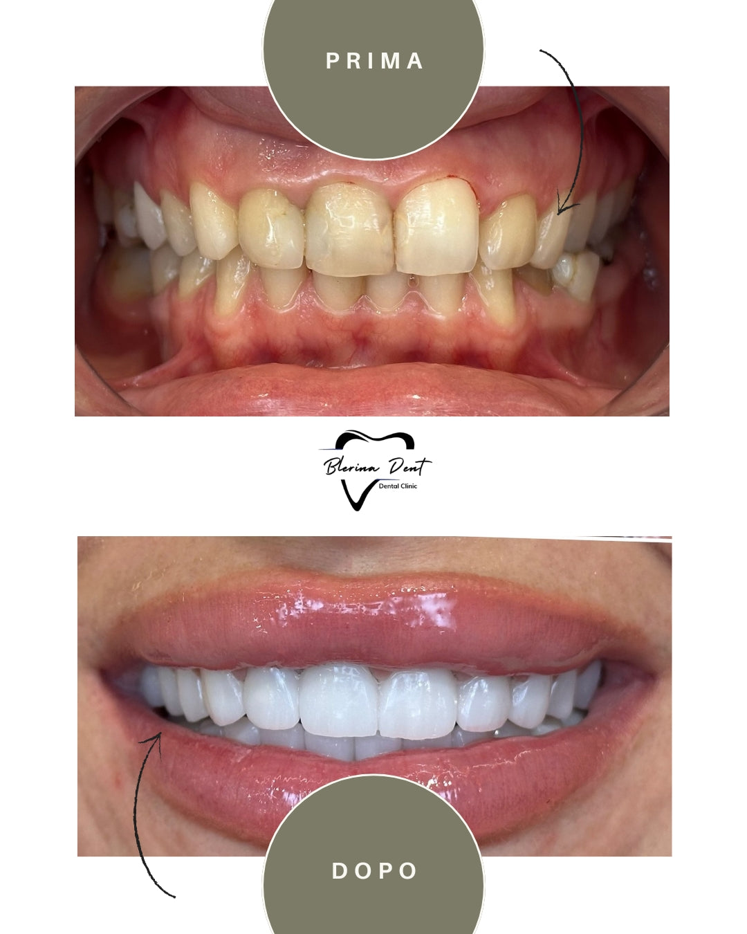 Corone in Zirconia Standard & Monolitica (full zirconia)