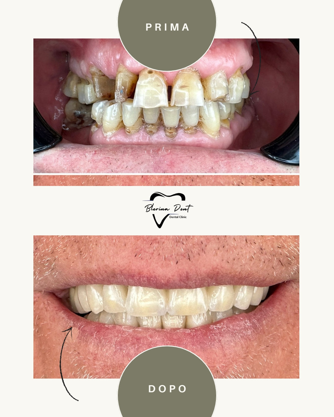 Corone metallo-ceramica: estetica e resistenza in un unico trattamento