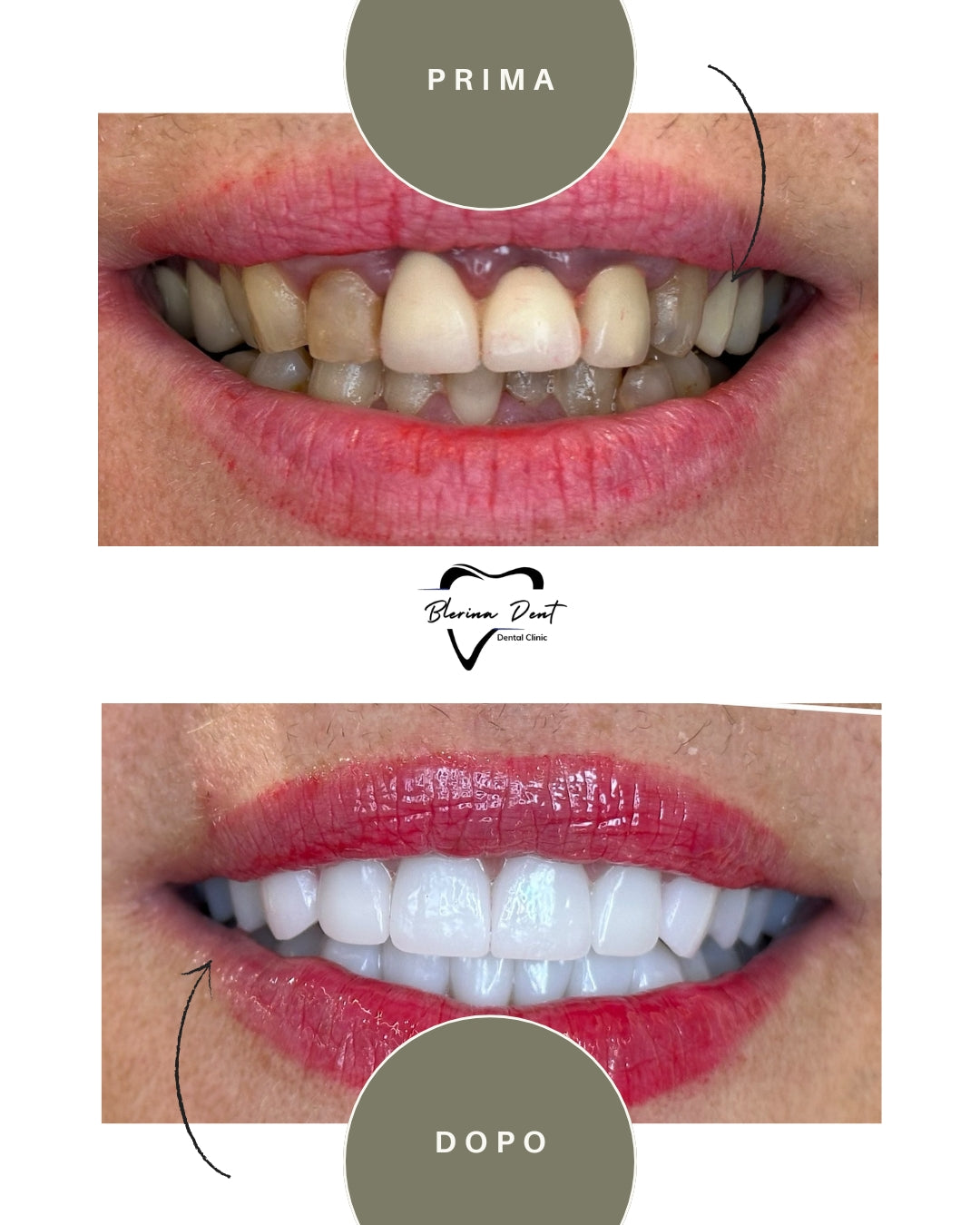 Corone in Zirconia Standard & Monolitica (full zirconia)