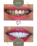 Corone in Zirconia Standard & Monolitica (full zirconia)