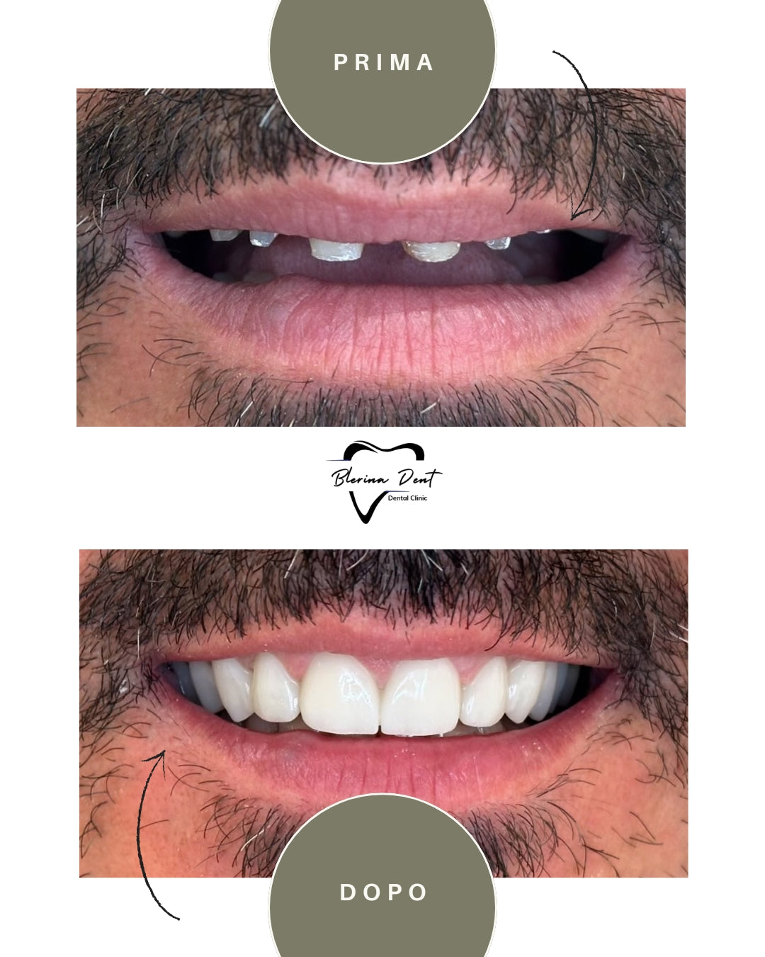 Corone in Zirconia Standard & Monolitica (full zirconia)