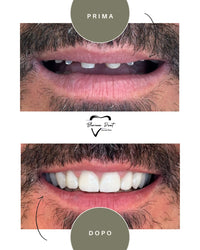 Corone in Zirconia Standard & Monolitica (full zirconia)