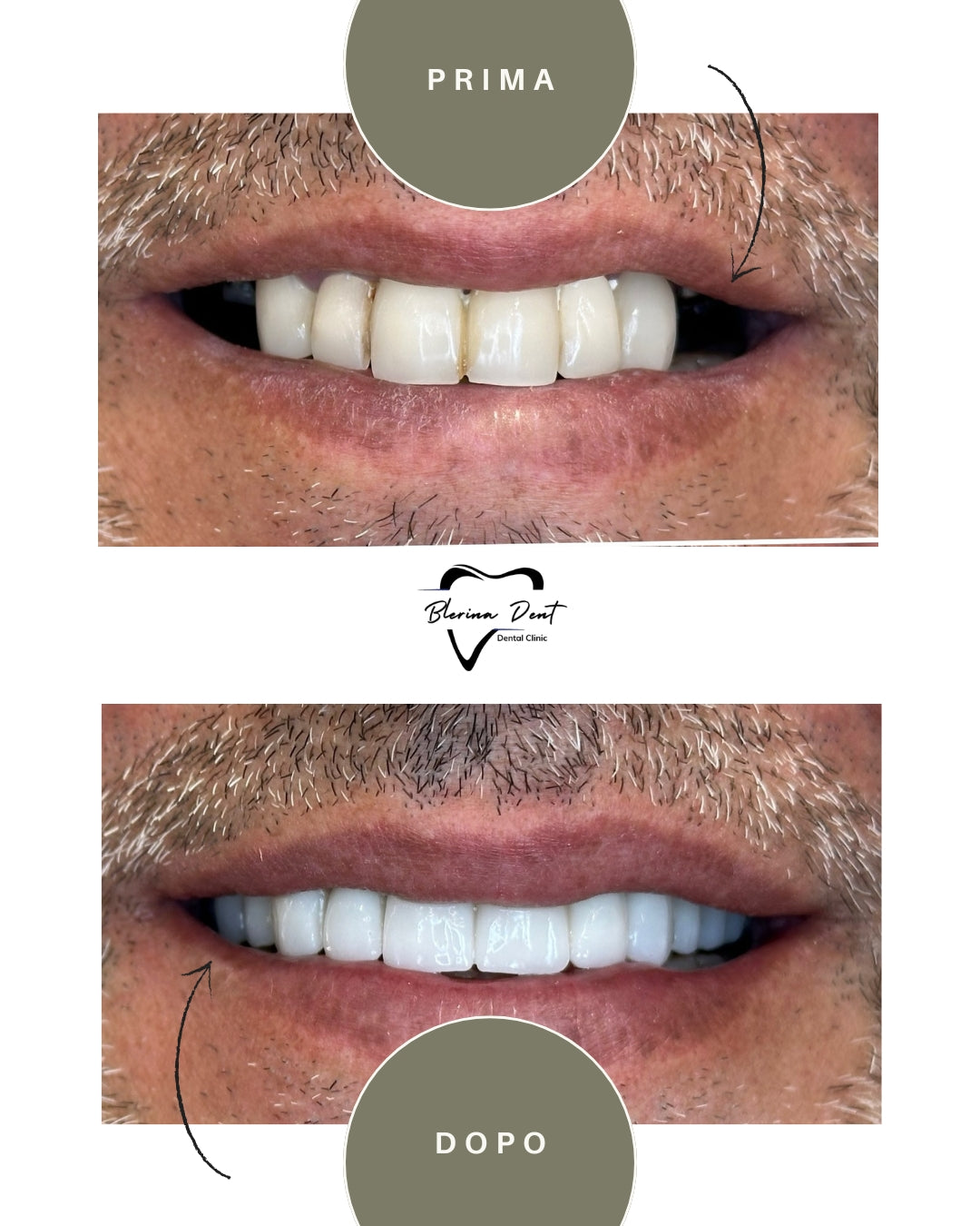 Corone in Zirconia Standard & Monolitica (full zirconia)
