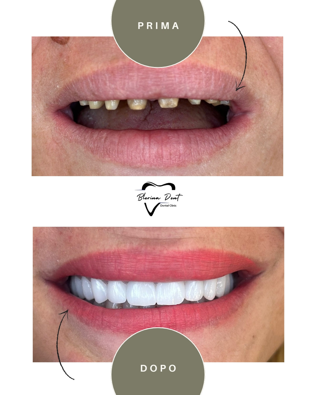 Corone in Zirconia Standard & Monolitica (full zirconia)