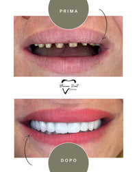 Corone in Zirconia Standard & Monolitica (full zirconia)