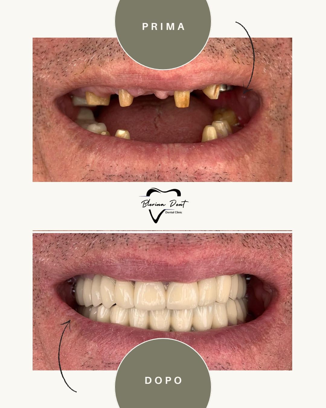 Corone metallo-ceramica: estetica e resistenza in un unico trattamento