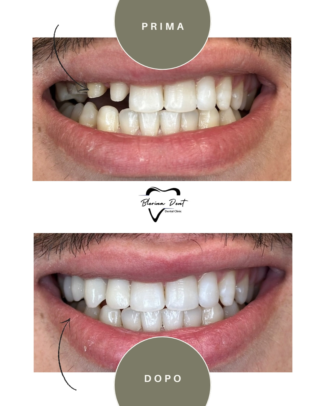 Corone in Zirconia Standard & Monolitica (full zirconia)