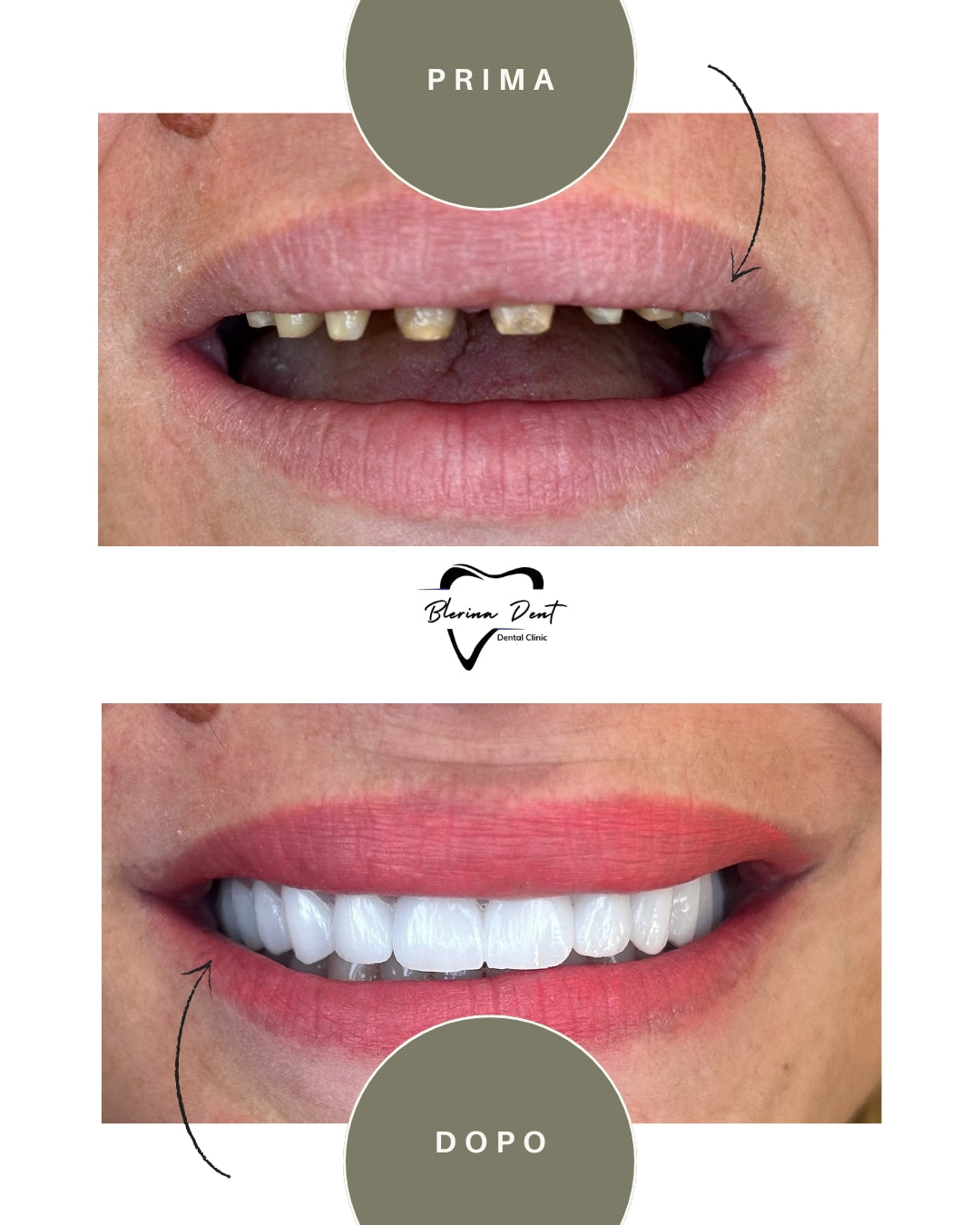 Corone in Zirconia Standard & Monolitica (full zirconia)