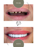 Corone in Zirconia Standard & Monolitica (full zirconia)